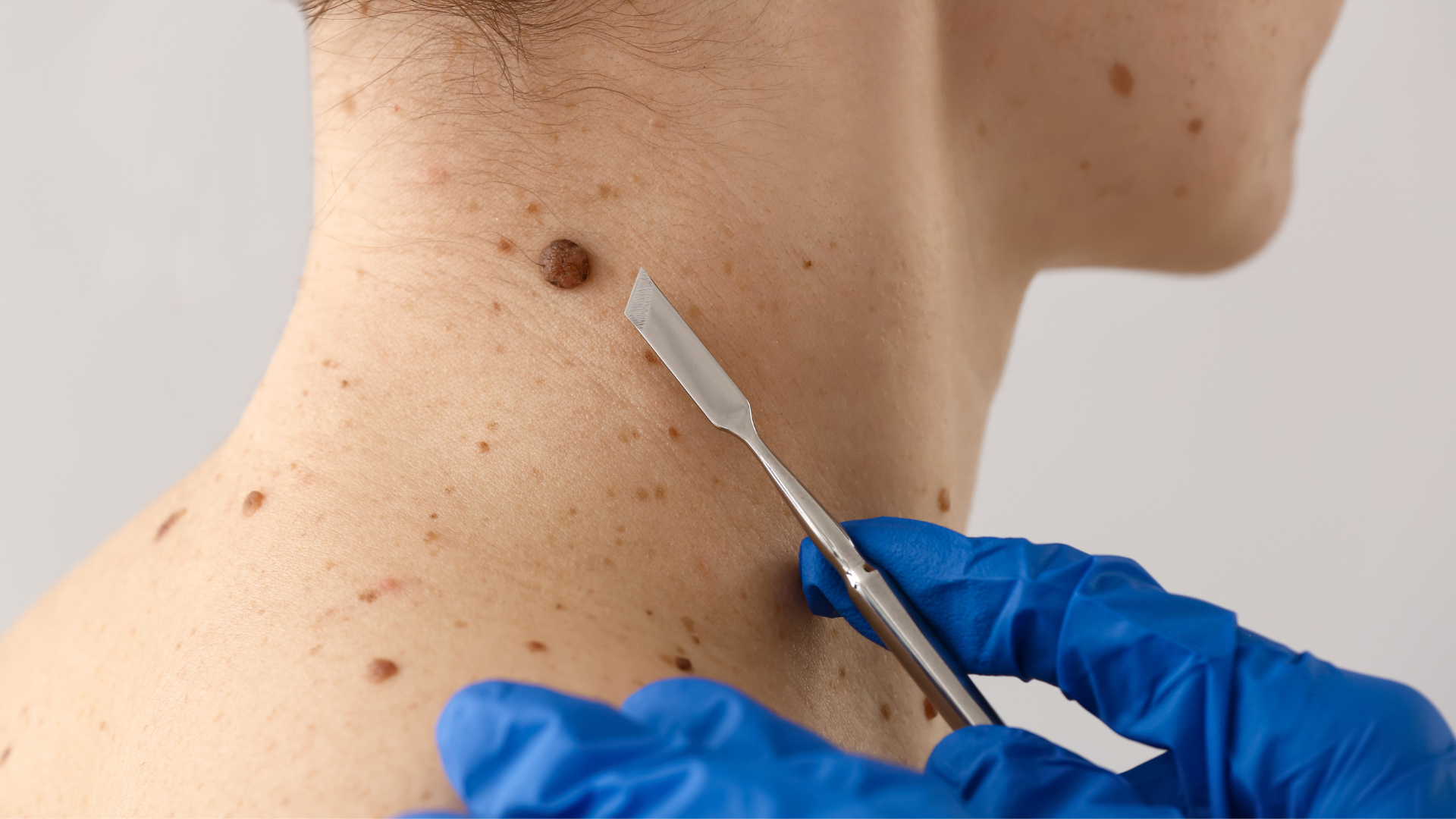 cancer de piel en chile