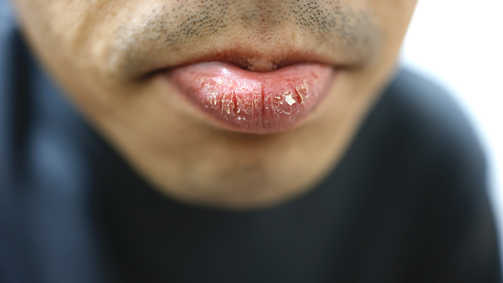 Labios secos y agrietados: el riesgo invisible en la gestión de riesgos
