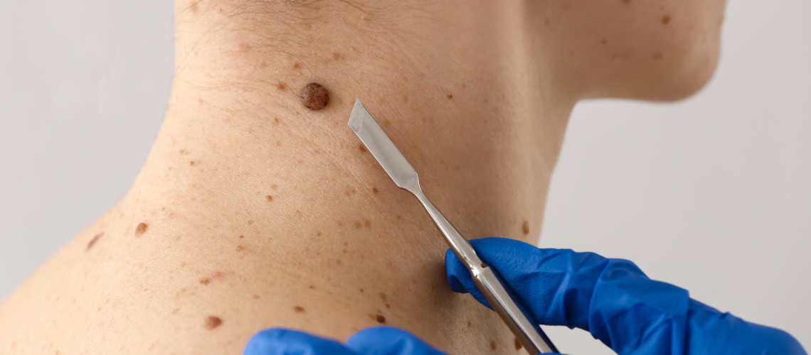 cancer de piel en chile