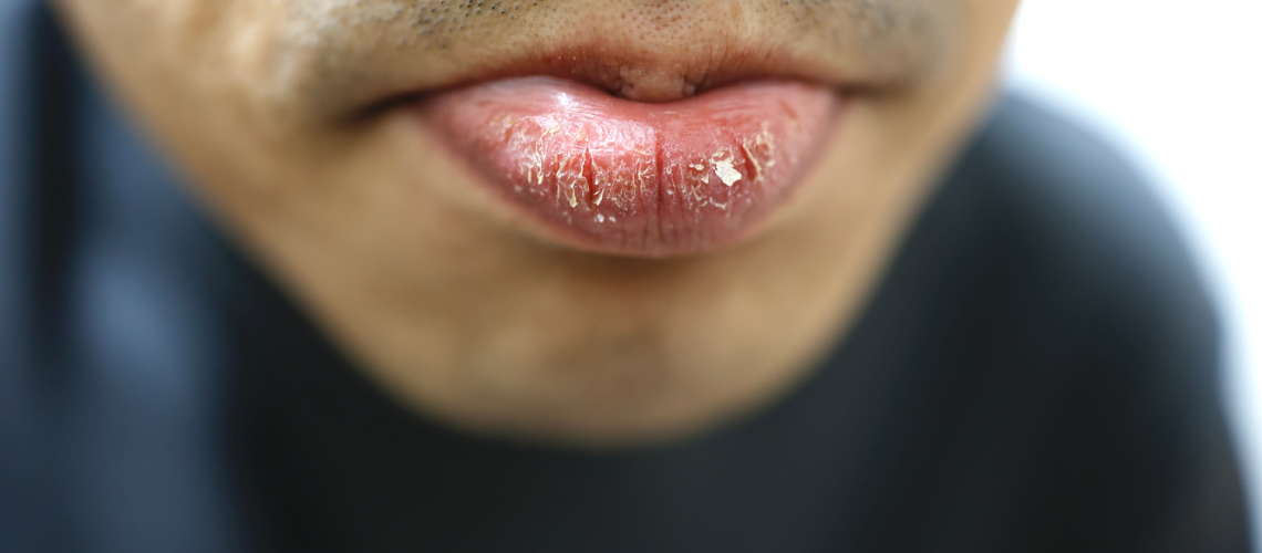 Labios secos y agrietados: el riesgo invisible en la gestión de riesgos